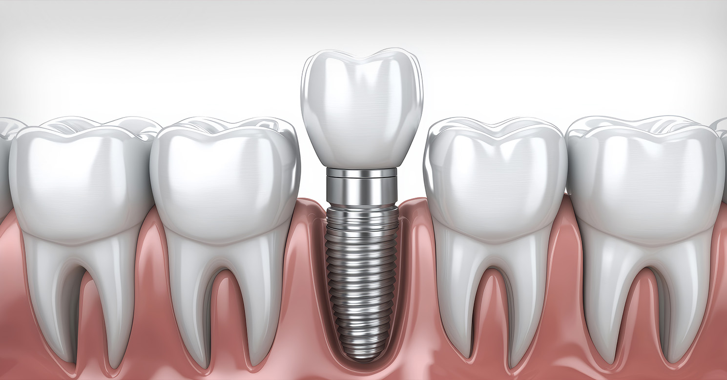 Diş İmplantları Hakkında Bilmeniz Gereken Her Şey - Dentica International