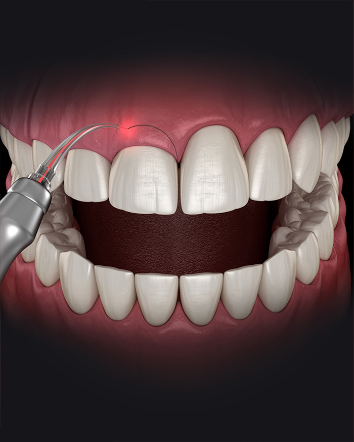 Lazer Gingivoplasti Nedir?