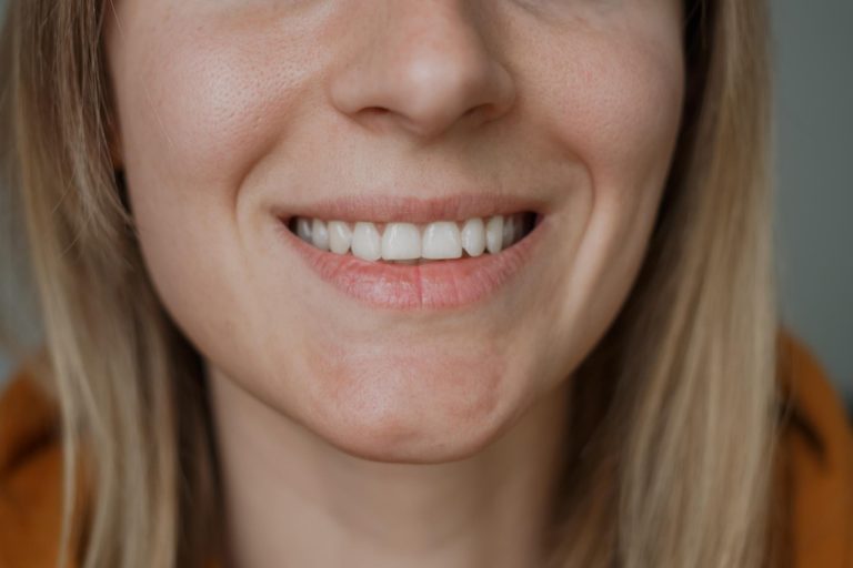 Dişlerde Beyaz Leke